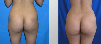 Butt Augmentation before 256432