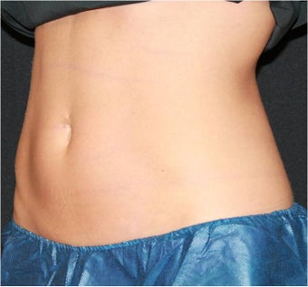 CoolSculpting before 420663
