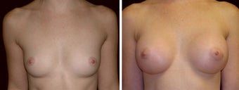 24 year old female, breast augmentation, San Francisco, California before 628385