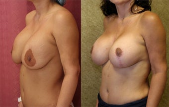 breast implant revision before 302667
