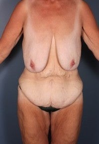 After Weight Loss, Body Lift, Breast Lift before 382293