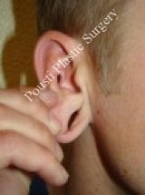 Earlobe Repair Surgery before 612298