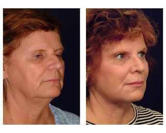 Neck Lift before 354243