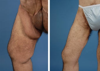 Thighplasty after 335981
