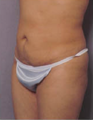 Abdominoplasty 428196