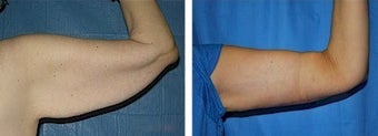 Arm lift before 245242