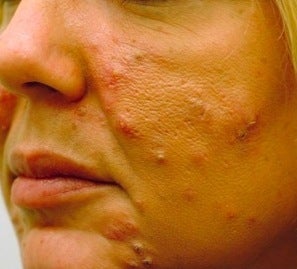 Acne treatment before 376128