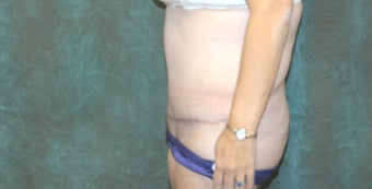 Women's Tummy Tuck Revision 558747