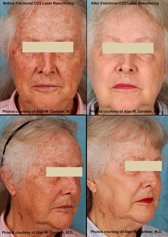 MiXto Laser Resurfacing before 130868