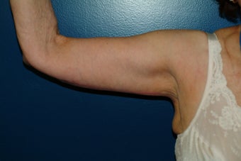 Brachioplasty after 575817
