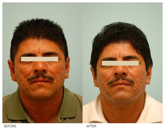 Acne Scarring Correction before 136799