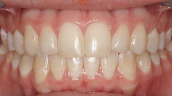 Upper Expander, Stunning Smile after 296521