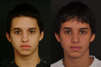 Rhinoplasty before 305995