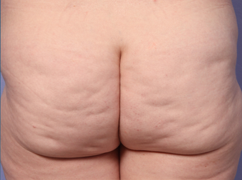 Cellulaze before 607911