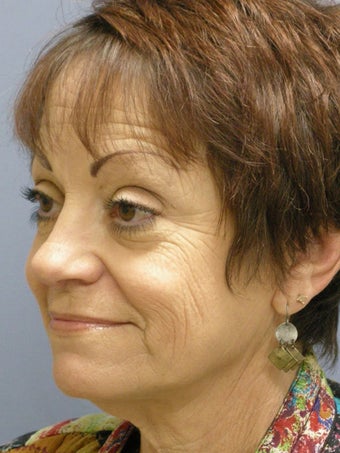 Lite Lift, Brow Lift before 523289