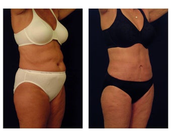 Liposuction after 397053