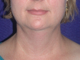 Necklift before 208455