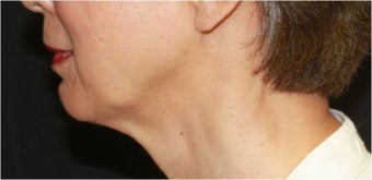 Ultherapy after 421635