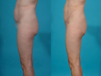 Liposuction; abdomen before 458972