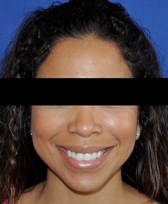 African American Rhinoplasty after 364918