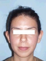 Ear Surgery (Otoplasty) before 357655