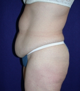 Tummy Tuck (abdominoplasty) 208482