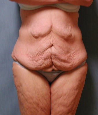 Lower Body Lift before 410337