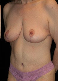 Body Lift after 363599