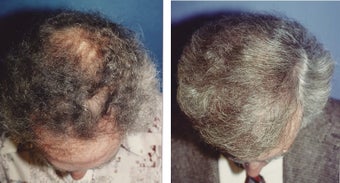 hair transplant after 369174
