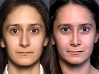 Nose Surgery before 338478