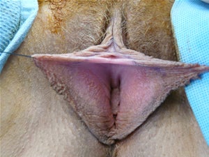 Labia Reduction Surgery before 93680