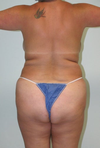 Brazilian butt lift 360607