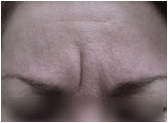 Botox before 267538