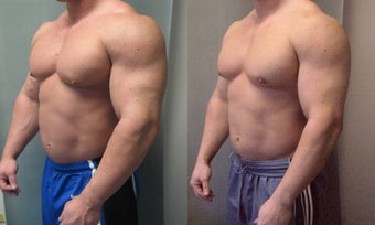 Gynecomastia after 350680