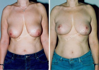 Mastopexy-Breast Lift before 243705