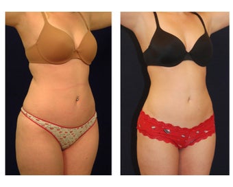 Liposuction before 286749