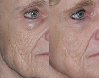 Fraxel repair with C02/Erbium lasers for Upper lip wrinkles before 104309