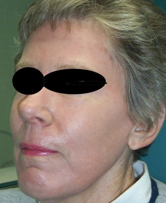 Full face laser resurfacing after 286172