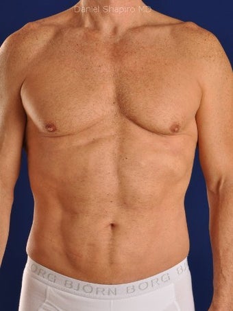 Vaser Hi Def Liposuction of chest, abdomen, back and flanks after 422687