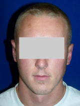 Ear Surgery (otoplasty) after 124909