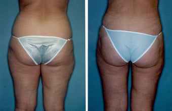 Liposuction before 314374
