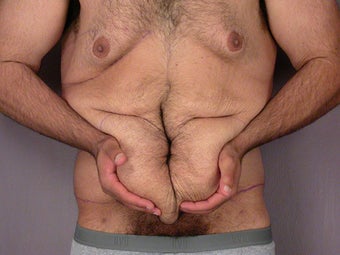 After Weight Loss before 280820