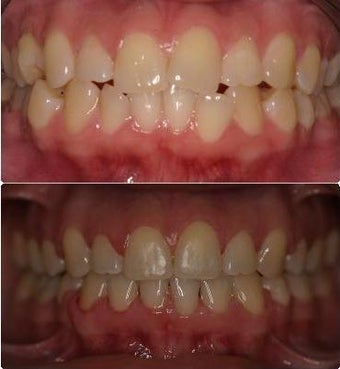 Extraction and space closure after 547361