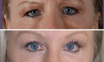 Browlift before 258807
