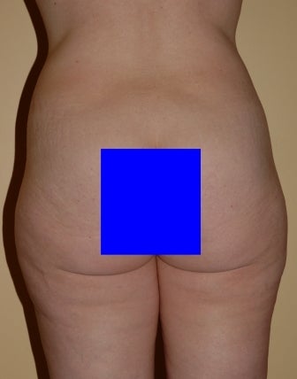 Vaser Liposuction before 230816