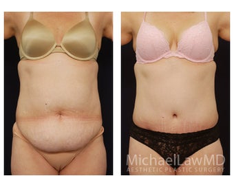 Abdominoplasty - Tummy Tuck before 396103