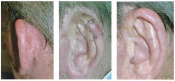 MOHS Skin Cancer Surgery before 369217
