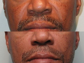 Nasal Labial Fold Correction with Silicone before 139176