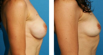 Breast Implant Removal with Internal Lift after 562127
