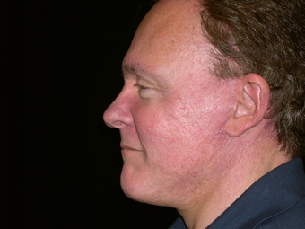 Facelift, Chin Implant, Browlift after 240047